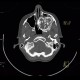 Fibrous dysplasia of the left maxillary sinus: CT - Computed tomography